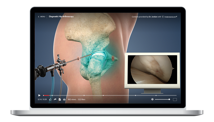 Diagnostic Hip Arthroscopy Animation
