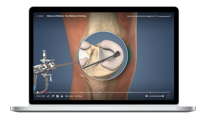 Meniscus Problems - Torn Meniscus Trimming Animation